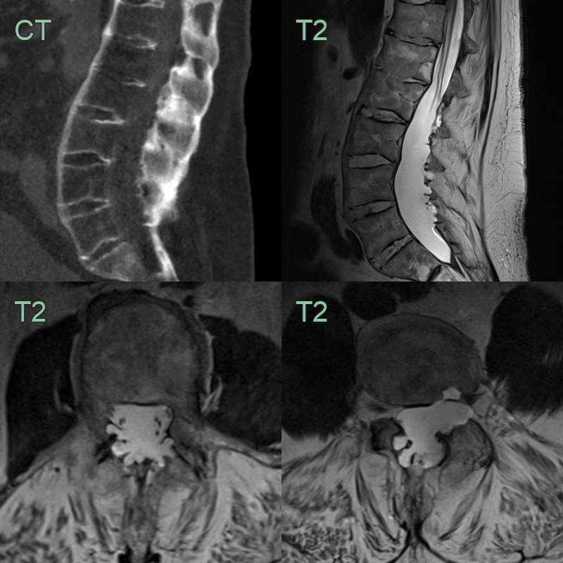 Ankylosing Spondylitis Neuroradiology
