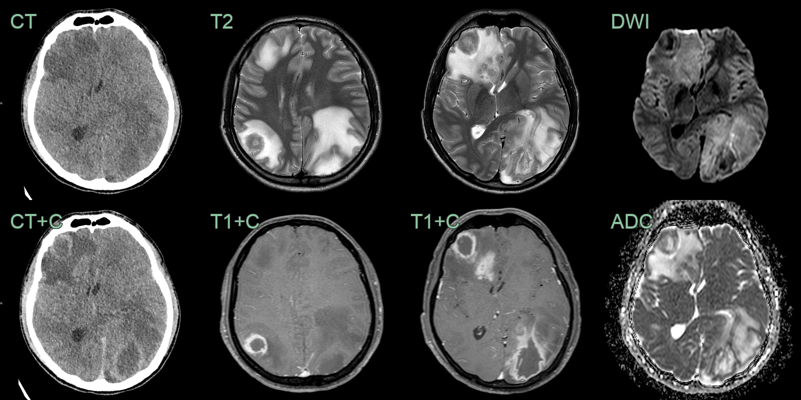 chagas_disease_1
