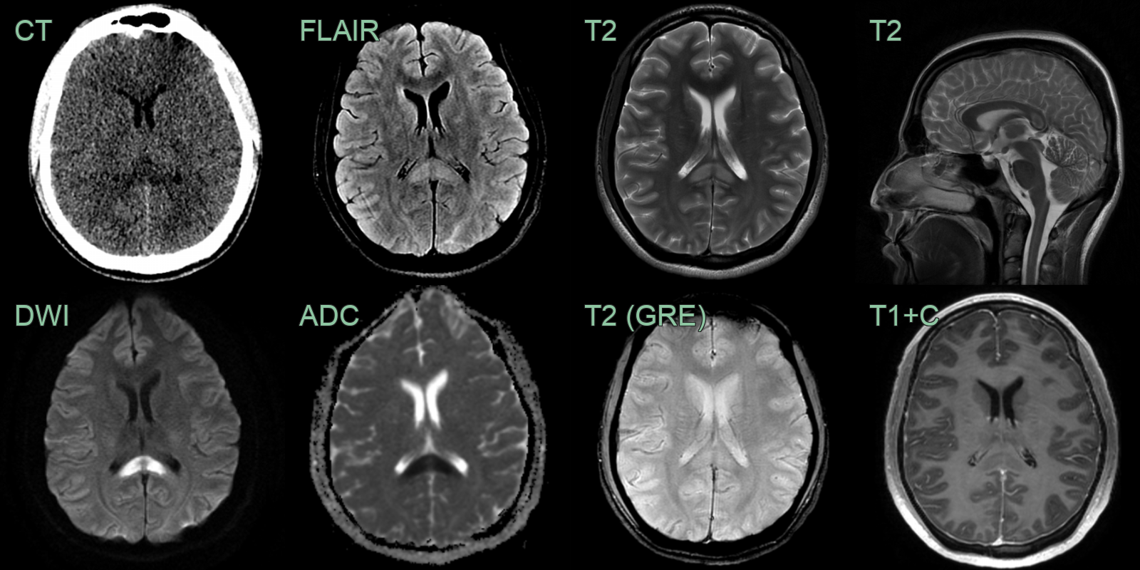 cytotoxic_lesion_of_the_corpus_callosum_1