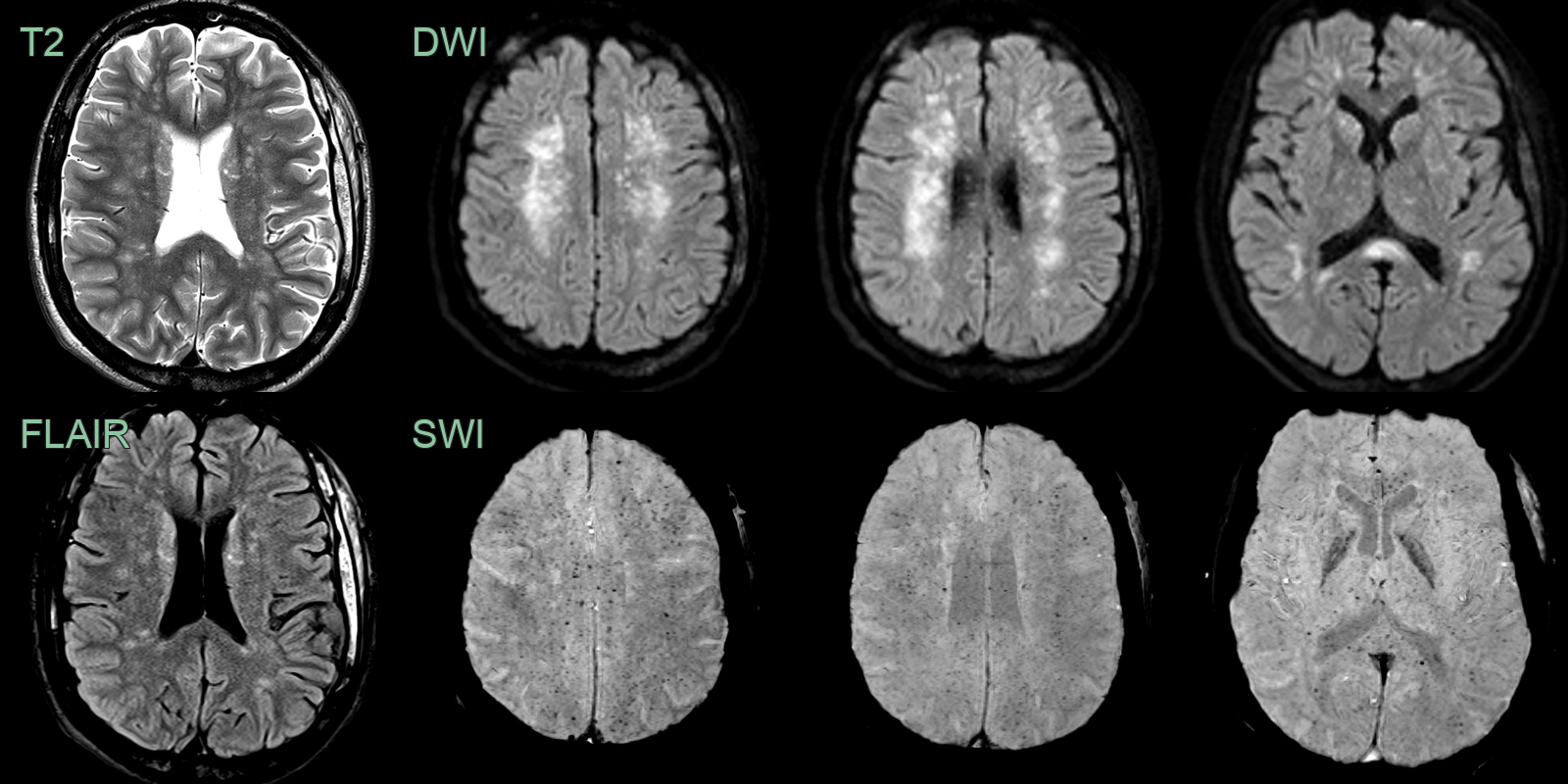 fat_embolisation_syndrome_1