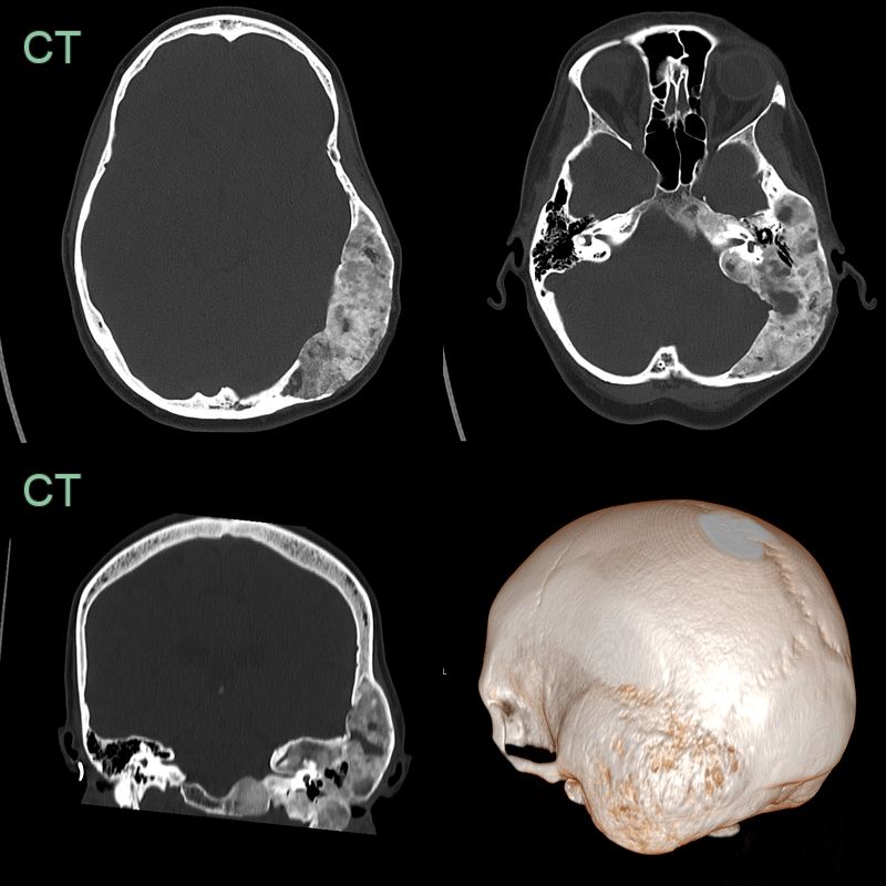 Fibrous dysplasia - Neuroradiology
