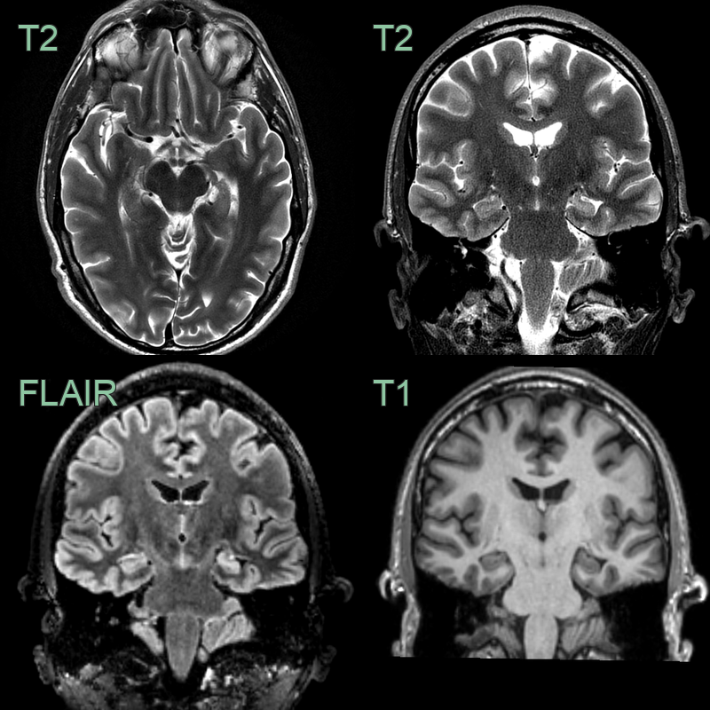 Mesial temporal sclerosis - Neuroradiology